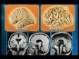 SuperQuark 2011 - Alzheimer